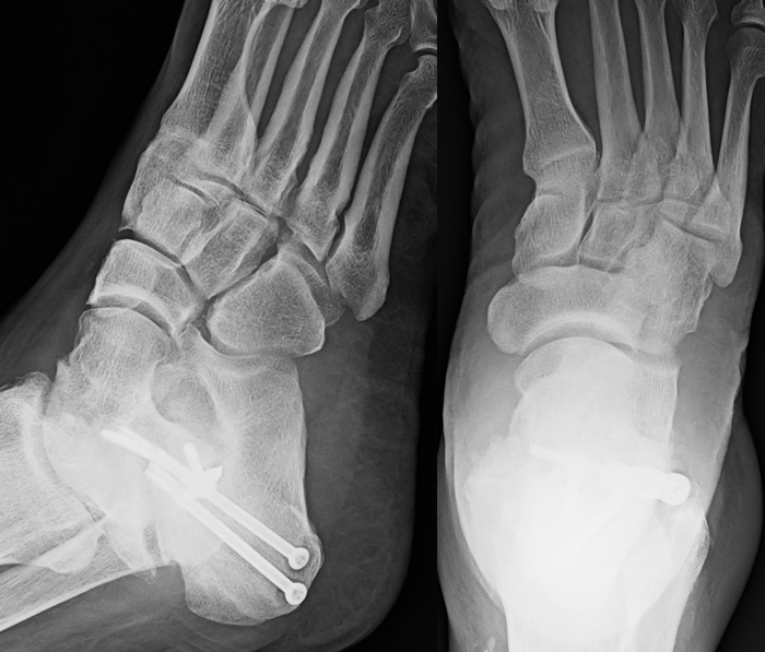 Case 1 AP and Oblique XRays